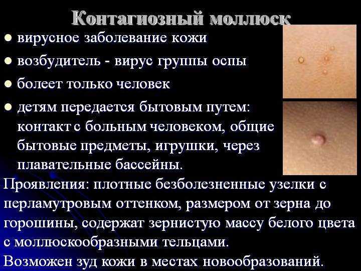 Контагиозный моллюск — от причин до лечения | evolutis clinic | дзен
