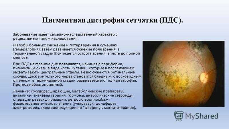 Наследственные дистрофии. Пигментный ретинит сетчатки. Пигментная абиотрофия сетчатки. Пигментный ретинит симптомы.